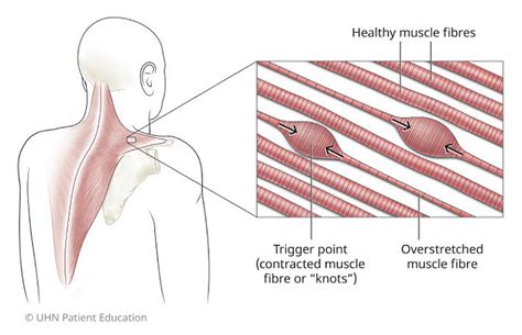 How to Heal From Myofascial Pain Syndrome - USA Sports Therapy