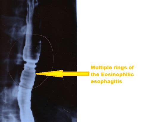 Upper gastrointestinal series - wikidoc