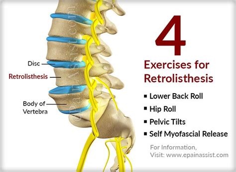 4 Exercises for Retrolisthesis | Ejercicios, Tratamientos, Salud