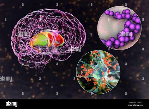 Sydenham's chorea, illustration Stock Photo - Alamy