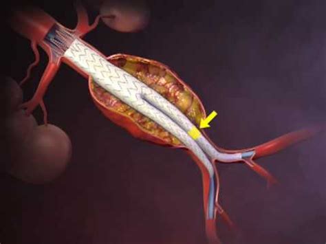 Abdominal Aortic Aneurysm Repair