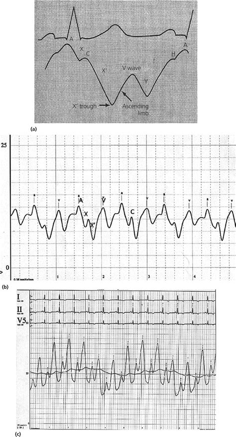 Cvp Waveform Atrial Fibrillation