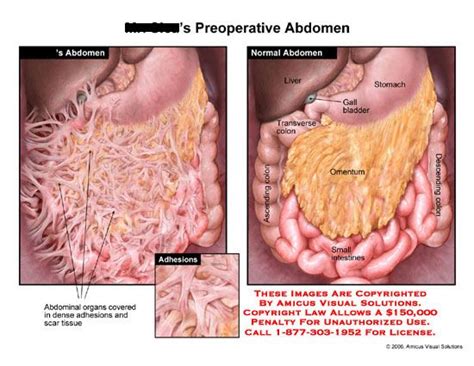 Intestines covered with dense adhesions, compared to normal anatomy ...