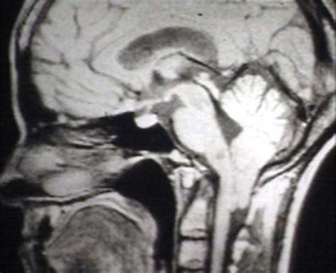 Arnold-Chiari malformation MRI - wikidoc