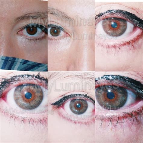 Eye Color Change Reviews Of Turkey And Laser Results