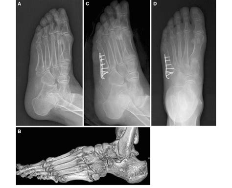 A 64-year-old woman with a fifth metatarsal base fracture. a... | Download Scientific Diagram