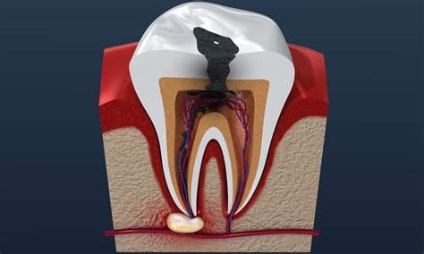 Tooth Abscess Stages Pictures : What To Look For?