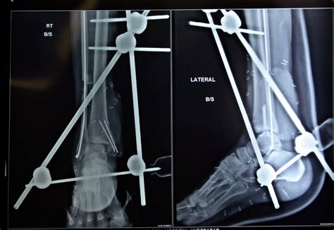 Avulsion Fracture Ankle - Fracture Treatment