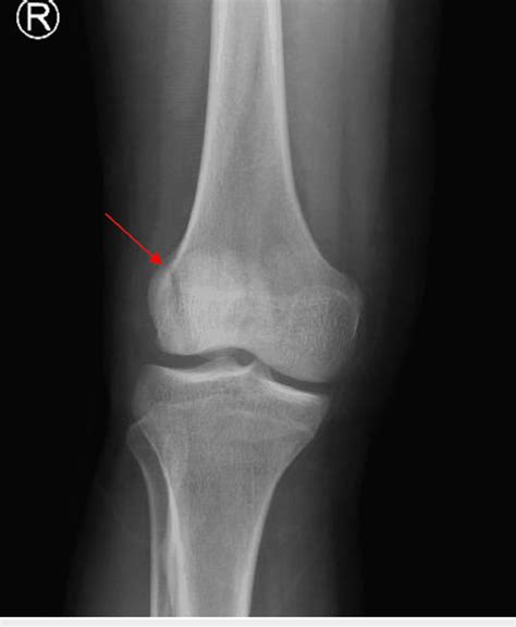 X-ray anteroposterior view of right knee showing a vertical type ...