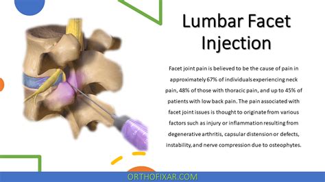 Lumbar Facet Injection | OrthoFixar 2024