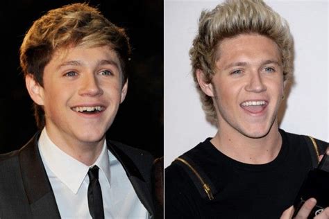 Celebrities' Teeth Transformations - Before and After [PHOTOS] | Niall ...