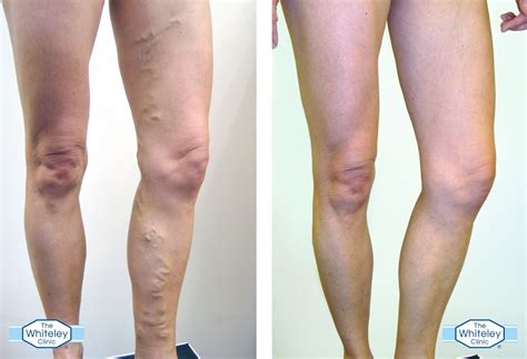 MedFriendly Medical Blog: Varicose Vein Treatment