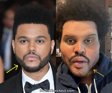 The Weeknd Plastic Surgery Comparison Photos