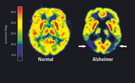 Frühtest für Alzheimer | MIT Technology Review | heise magazine