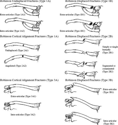 Clavicle Fractures | Musculoskeletal Key