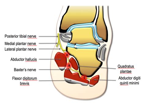 Baxter\'s neuropathy: Isolated fatty atrophy of the abductor digiti minimi muscle in association ...