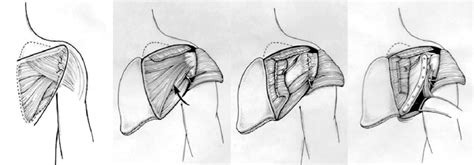 An extended posterior approach is utilized to expose the glenoid,... | Download Scientific Diagram