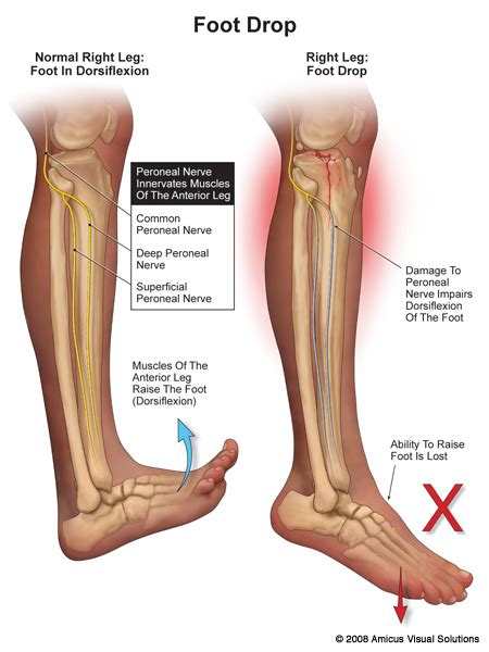 Common Peroneal - Podiatry, Orthopedics, & Physical Therapy