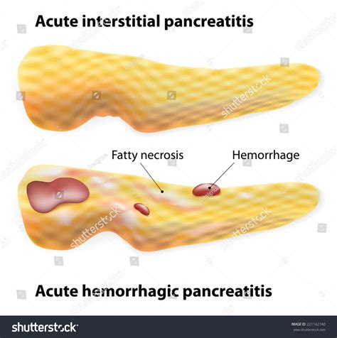 Acute Pancreatitis Acute Interstitial Pancreatitis Acute: เวกเตอร์สต็อก (ปลอดค่าลิขสิทธิ์ ...