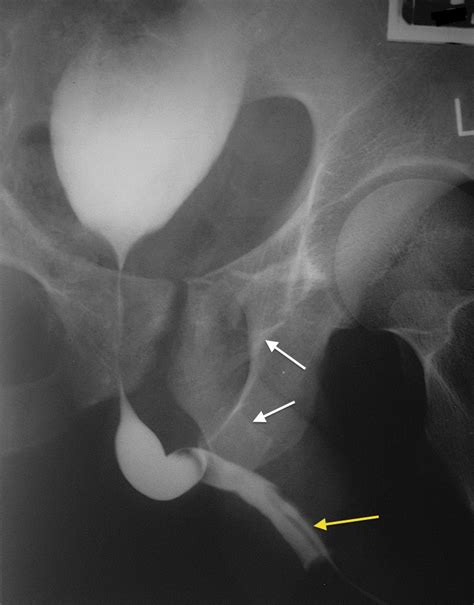 Retrograde urethrogram - Radiology at St. Vincent's University Hospital