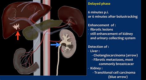 The Radiology Assistant : CT contrast injection and protocols