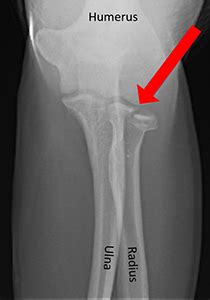 Ulna Hairline Fracture