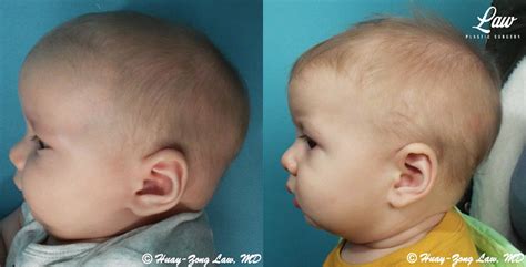 Craniosynostosis Before & After Photos - Sage Plastic Surgery