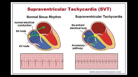 Olivia Health Video Presentation Supraventricular Tachycardia Svt | My XXX Hot Girl