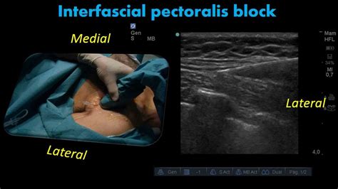 Ultrasound Interfascial pectoralis block - YouTube