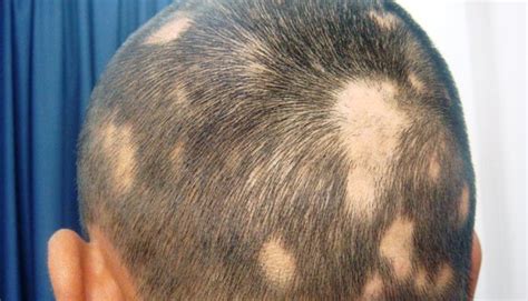 Treatment and causes of white hair patches - Yabibo.com