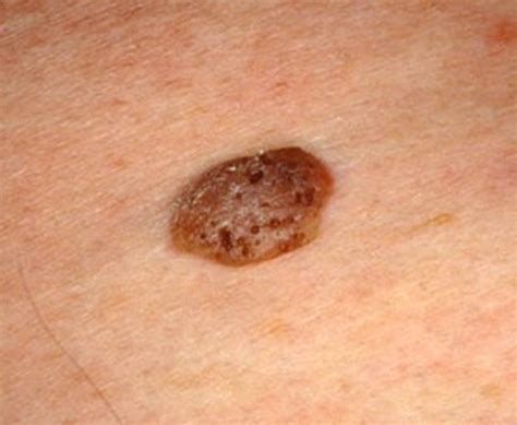 Seborrheic Keratosis - Pictures, Symptoms, Treatment, Removal and Causes | HubPages