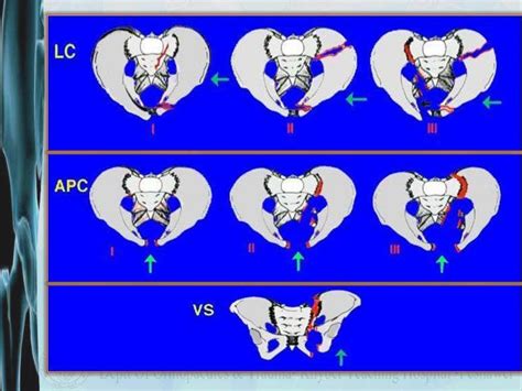 Pelvic fracture classification