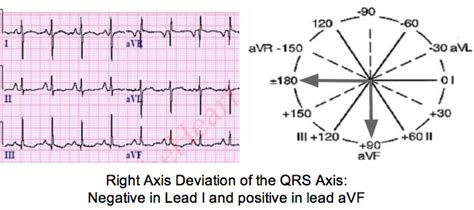 Determine Axis on a 12-lead ECG Tracing | LearntheHeart.com