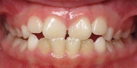 Metal Braces - Ceramic Braces vs Metal vs Clear Braces & Cost