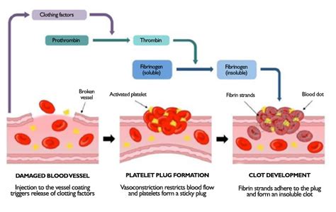 5 things to know about thrombosis in PICCs - Campus Vygon