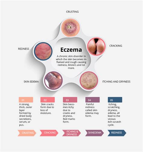 Atopic Dermatitis - Eczema Infographic - Interesting Facts 2019