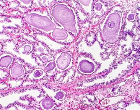 Prostate biopsy