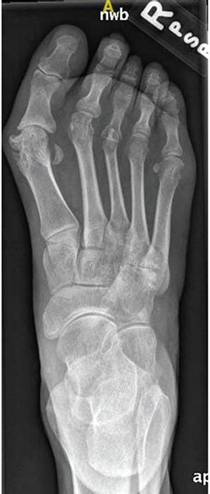 Diagnostic Imaging in Lupus Patient with Foot Pain: Findings - The ...