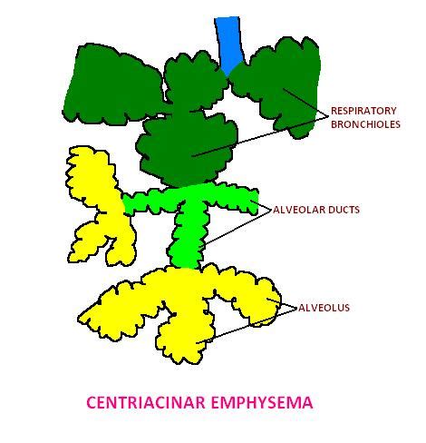 Medicine Unleashed!!!: COPD & EMPHYSEMA