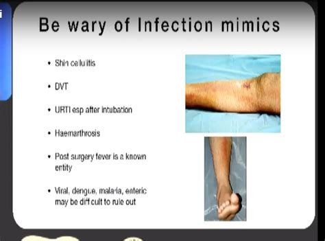 Managing Infection after ACL Reconstruction — OrthopaedicPrinciples.com