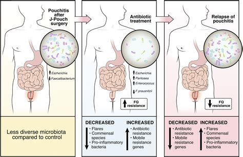 Exposing the Achilles Heel of Antibiotic Therapy for Pouchitis Using ...