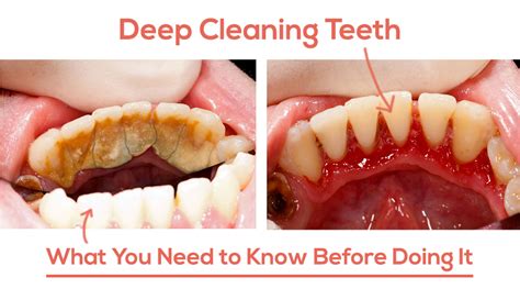 Deep Dental Cleaning: 7 Surprising Benefits You Never Knew » Top ...