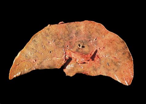 Necrosis Of The Liver Photograph by Science Photo Library - Pixels