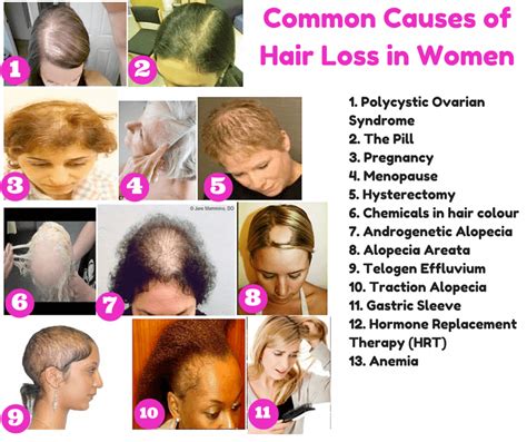 How To Stop Losing Hair Naturally Tips Faqs And Hair Care - Best Simple Hairstyles for Every ...