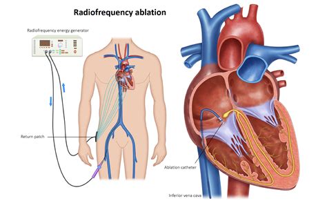 SVT Ablation - Melbourne Heart Group