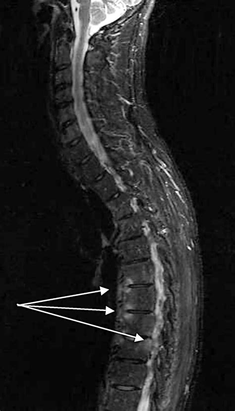 Inflammation in ankylosing spondylitis: a systematic description of the ...