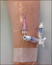 Peripheral intravenous catheter assessment: beyond phlebitis - The Lancet Haematology