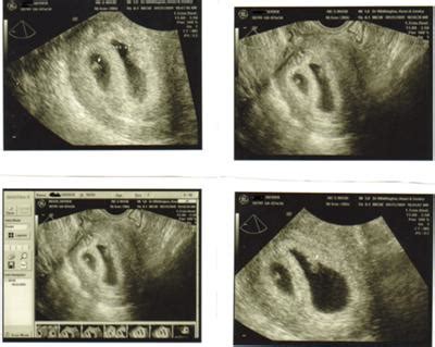 Twins Ultrasound At 6 Weeks