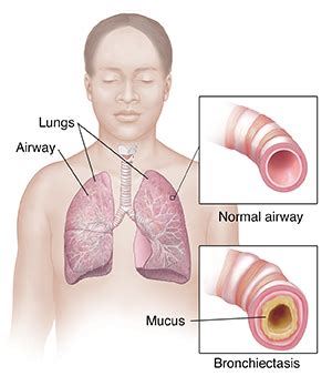 Bronchiectasis: Causes, Symptoms, Treatment Prevention, 56% OFF