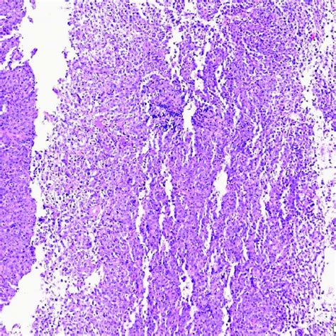 Histologic findings of nasal biopsy of Case N.2. The submucosa is ...